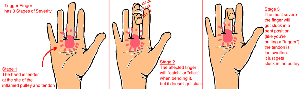 How do you treat trigger finger pain?
